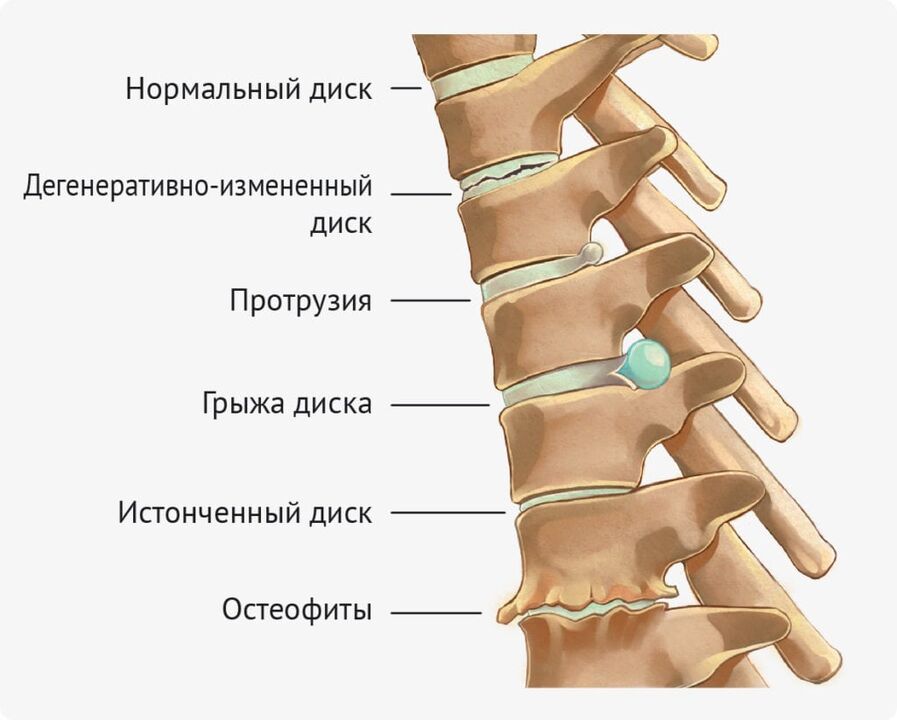 Deformități de disc pentru osteocondroza lombară