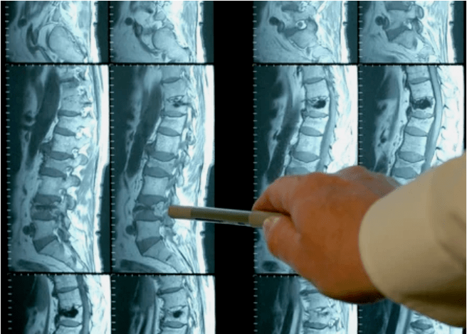 Soiuri de osteochondroză la nivelul coloanei vertebrale