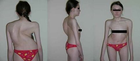 curbura coloanei vertebrale ca urmare a osteochondrozei