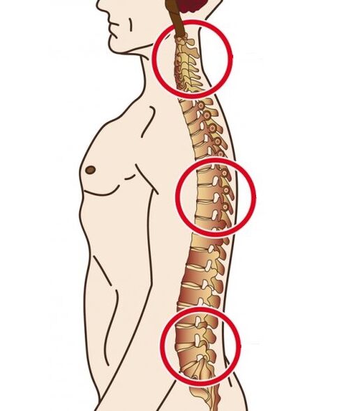 departamente ale coloanei vertebrale în care are loc osteochondroza