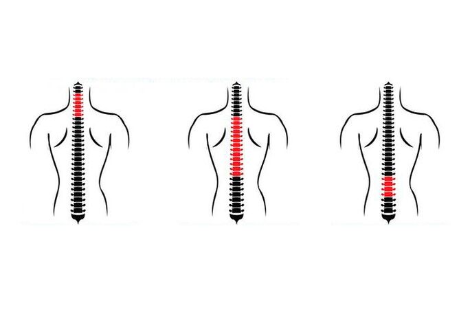 Cum se manifestă osteocondroza