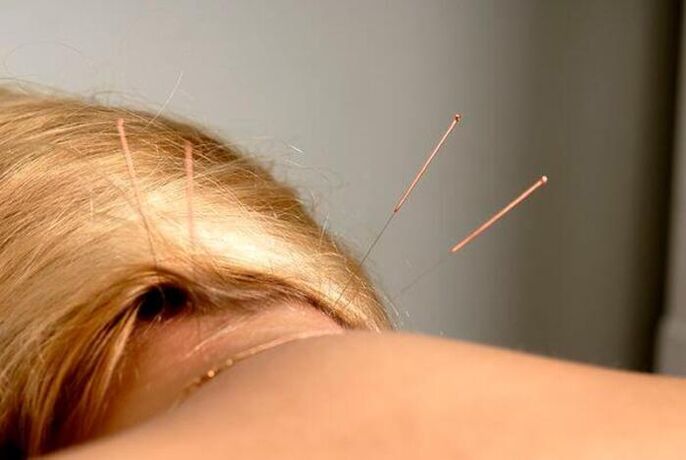 acupunctura pentru osteocondroză