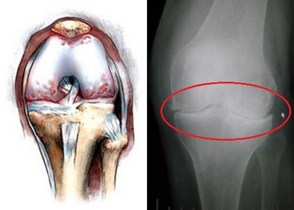 osteoartrita articulației genunchiului