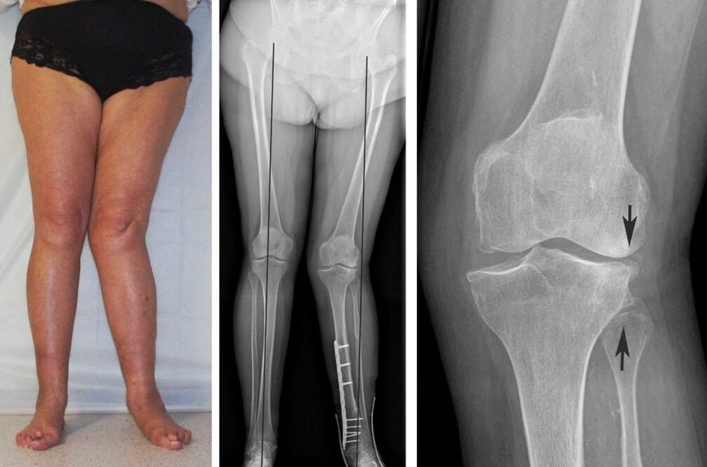 Artroza avansată a articulațiilor genunchiului este clar vizibilă chiar și fără raze X