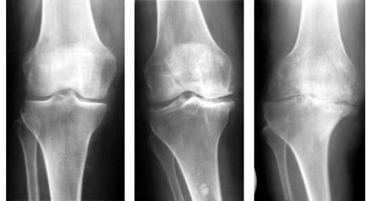 O măsură de diagnostic obligatorie la identificarea artrozei genunchiului este o radiografie