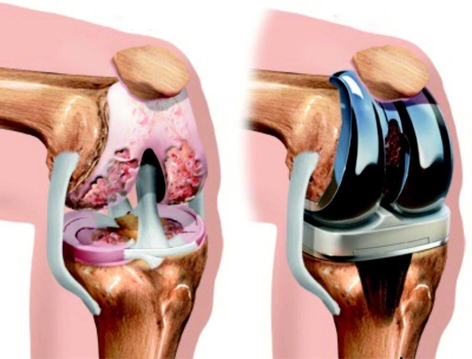 În cazul unei leziuni totale a articulației genunchiului prin artroză, aceasta poate fi restaurată prin endoprotezare